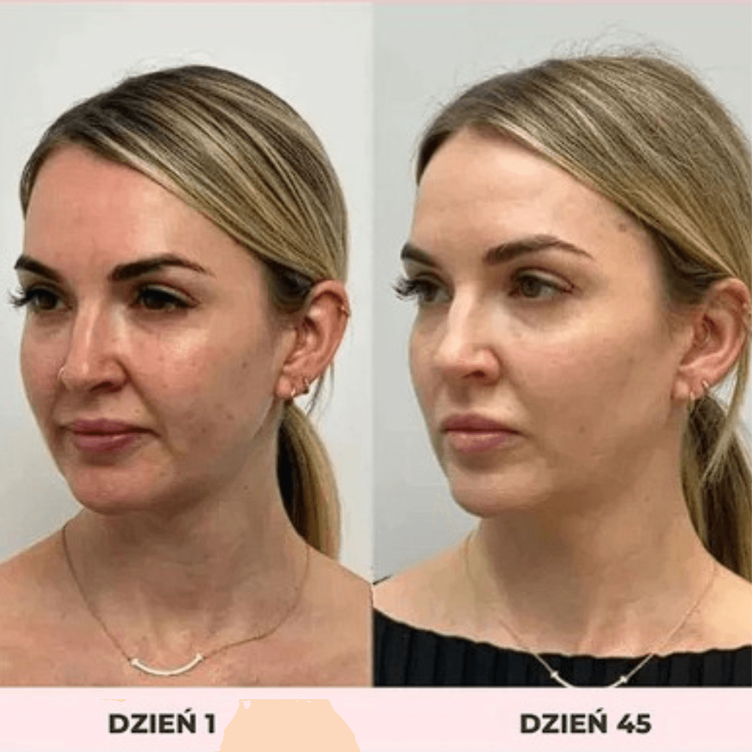 LIFTEE Sonic EMS – na Obwisłe Policzki i Zmarszczki